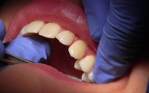 人家的名字是玻璃离子水门汀——才不想叫什么齿科水泥