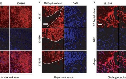 Adv. Mater. :荧光2D肽片表明CD47可作为肝细胞癌/肝外胆管癌组织的生物标记物